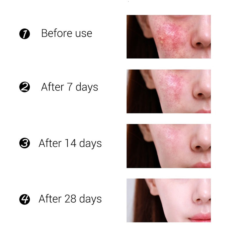 RtopR mango acne cream