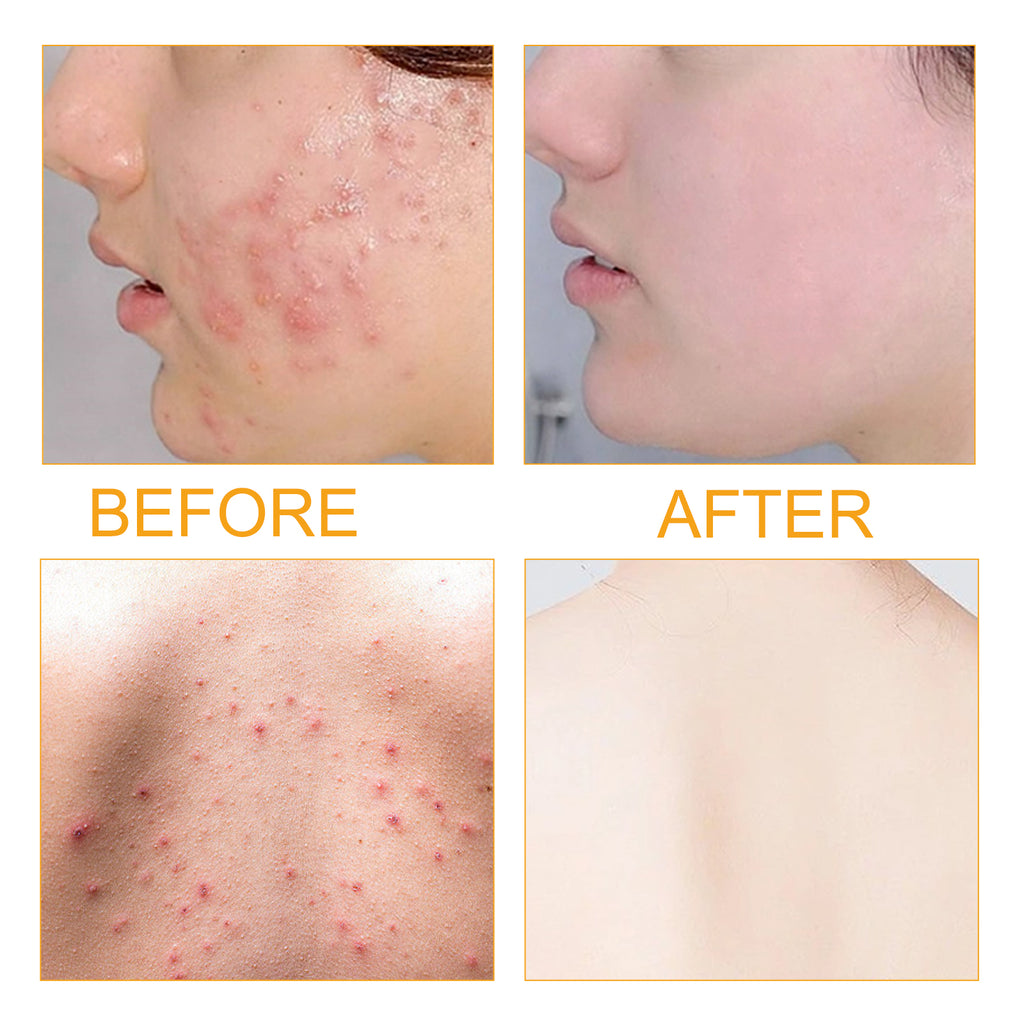Acne repair face serum