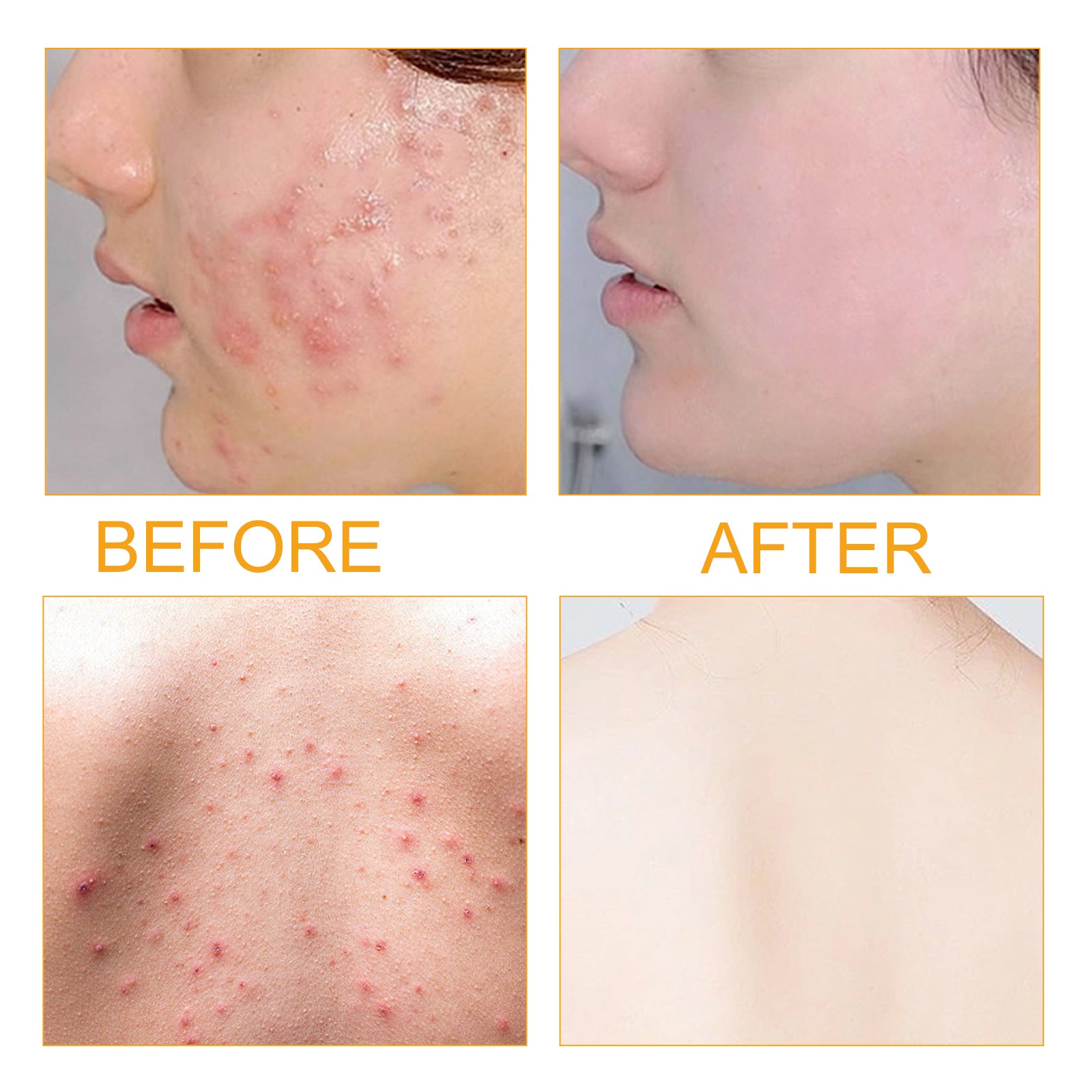 Acne repair face serum